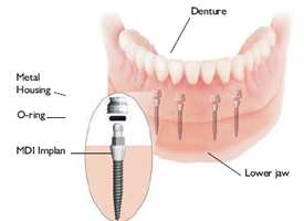 Mini Dental Implants